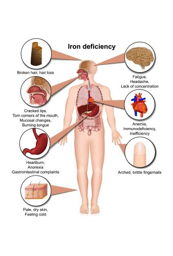 Iron deficiency